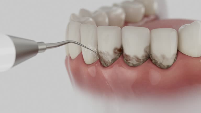 Reliable Dental Implants contractor in Fircrest, WA by Smile Center Dentistry